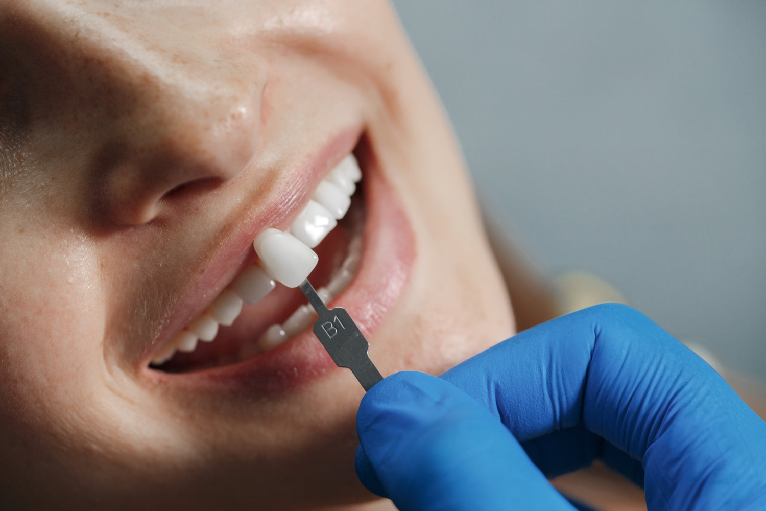 Problems Of Using Zirconia Crowns And How To Avoid Them