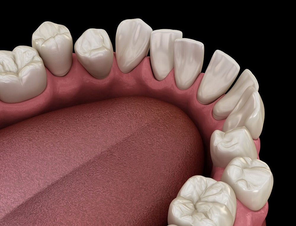 Misaligned Teeth