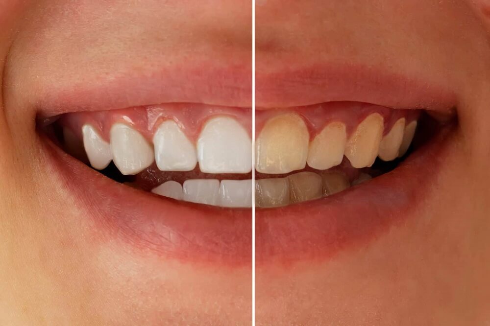 Can Tooth Decay be Reversed