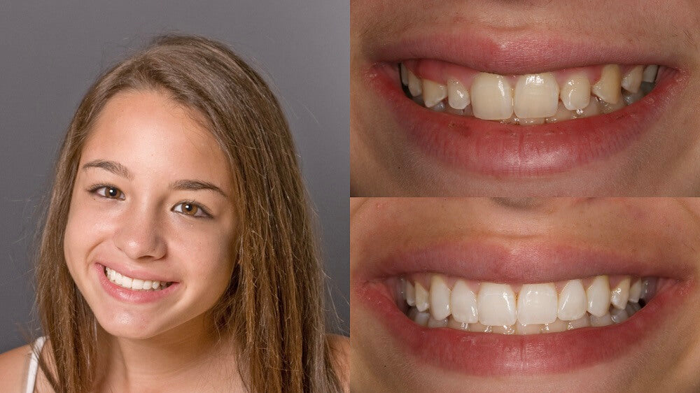 Dental Bonding Before and After