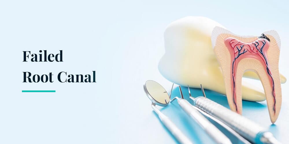 Failed Root Canal Symptoms