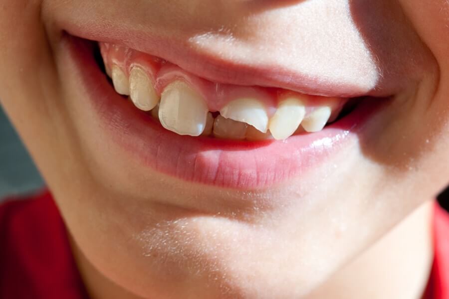 How much does it cost to fix a Chipped Tooth