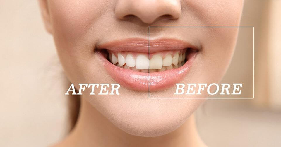 How to Fix Stained Teeth