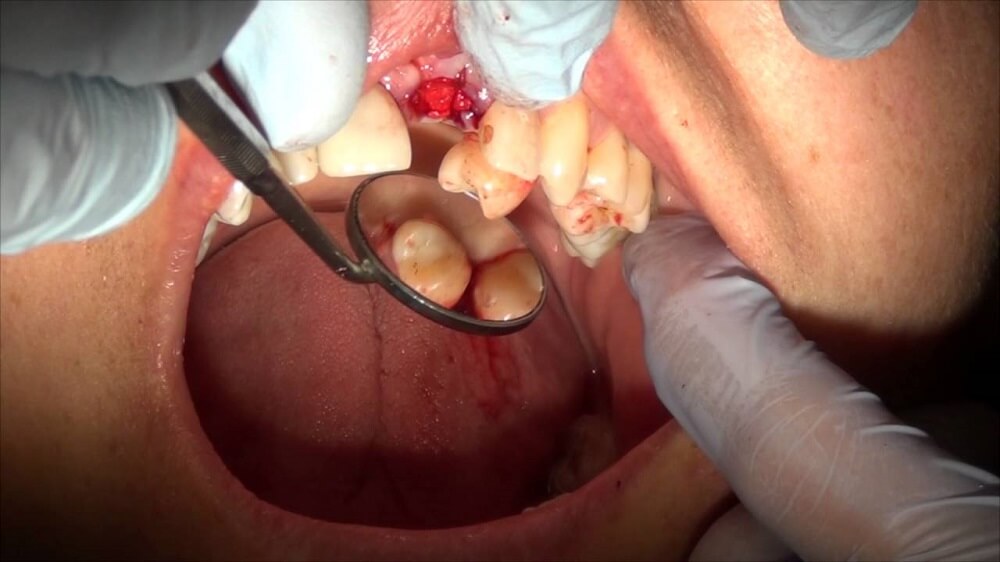 How to Remove Hyperdontia
