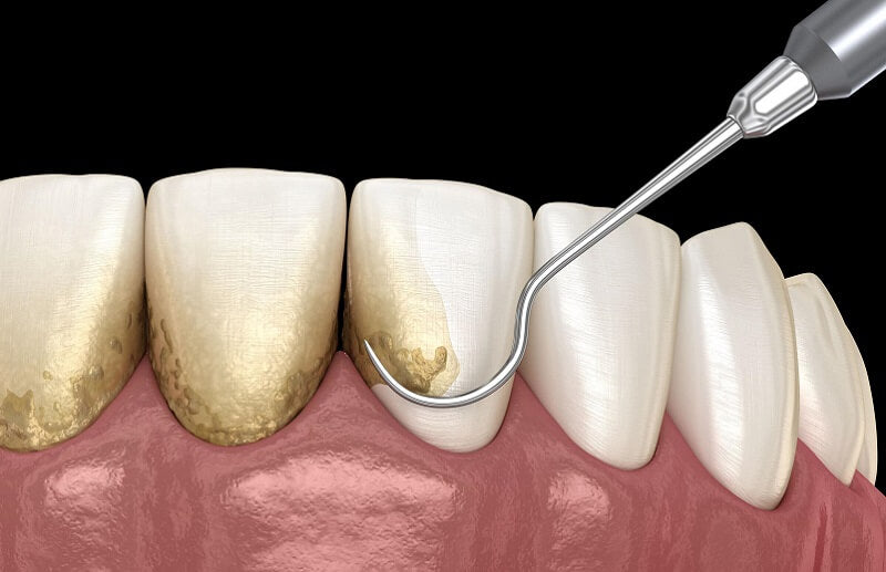 how to remove tartar from teeth