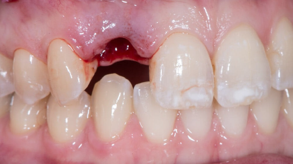 Loose Tooth Tighten Back up After Injury