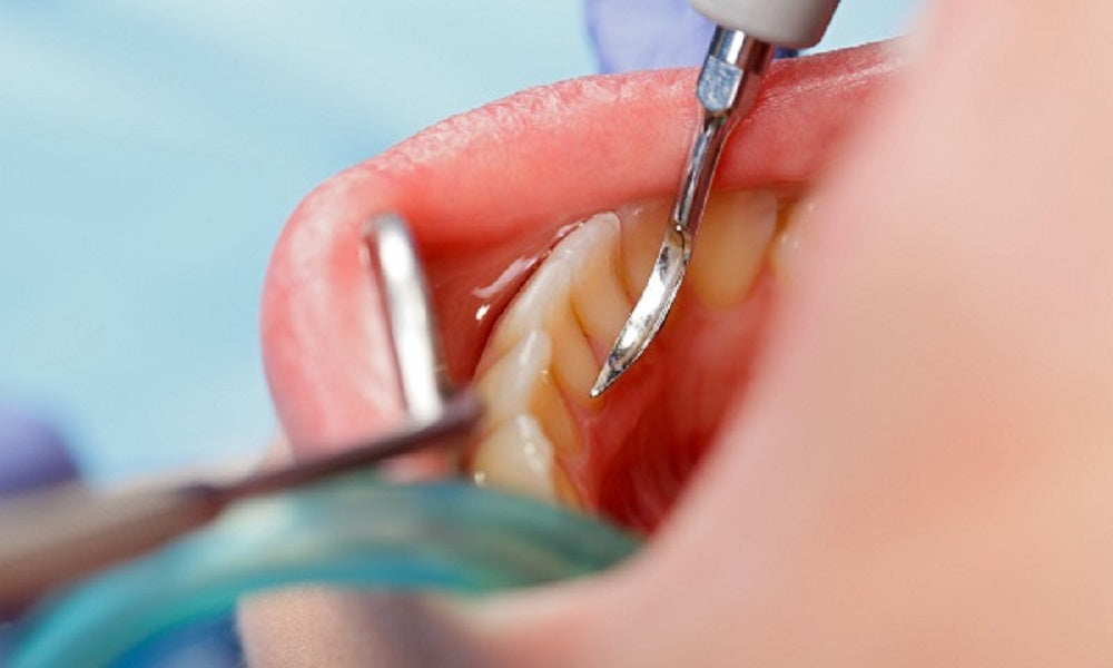 Root Canal