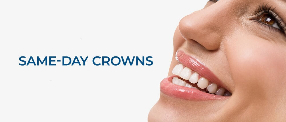Same Day Crowns