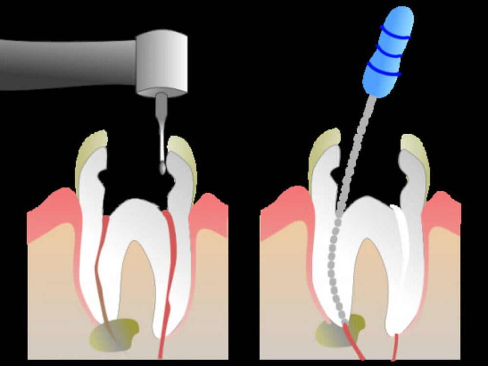Abscess After Rct What are the Symptoms of Jaw Infection After Root Canal? – Franklin ...