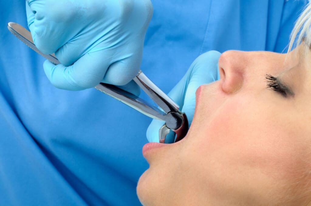 What is Full Mouth Extraction
