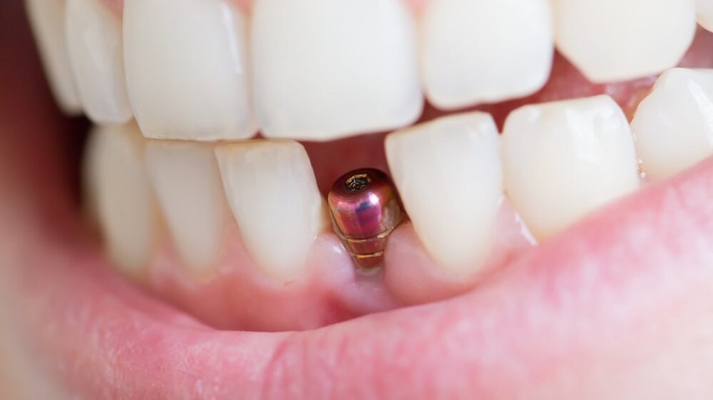 What is a Bone Graft Dental Procedure