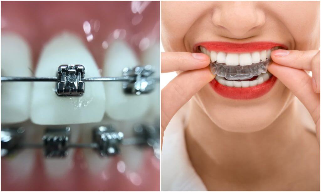 Whitening Invisalign