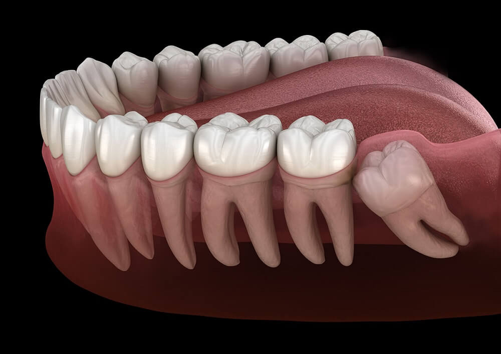 can wisdom teeth grow back