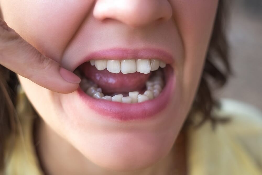 How to Fix Crooked Teeth?