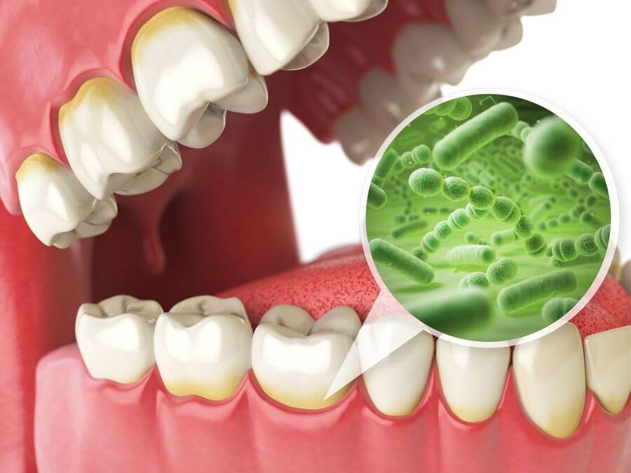 does gingivitis cause bad breath
