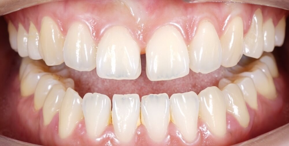 How to Reduce Gap Between Teeth Naturally at Home: Simple and Effective DIY Techniques