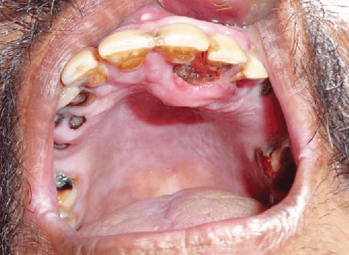 mouth maggots