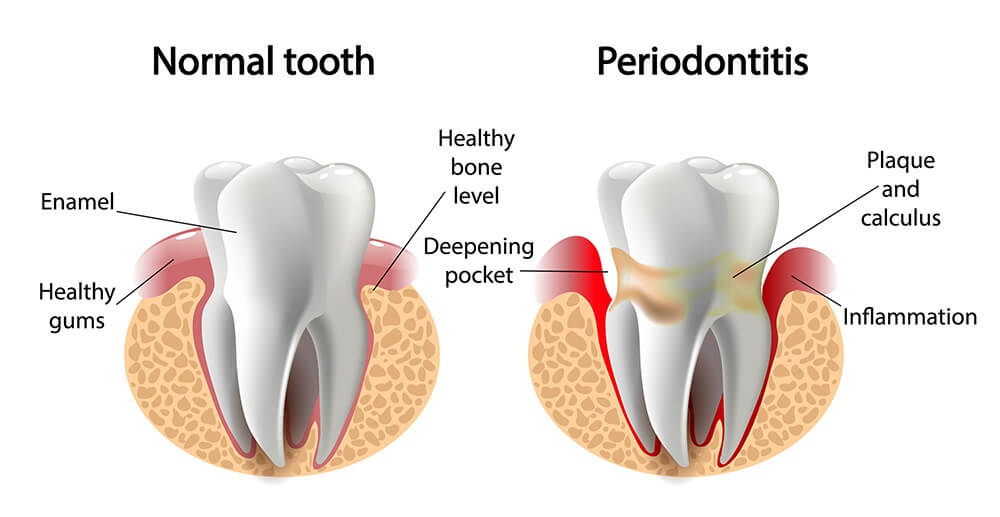Gingivitis take to turn into Periodontitis
